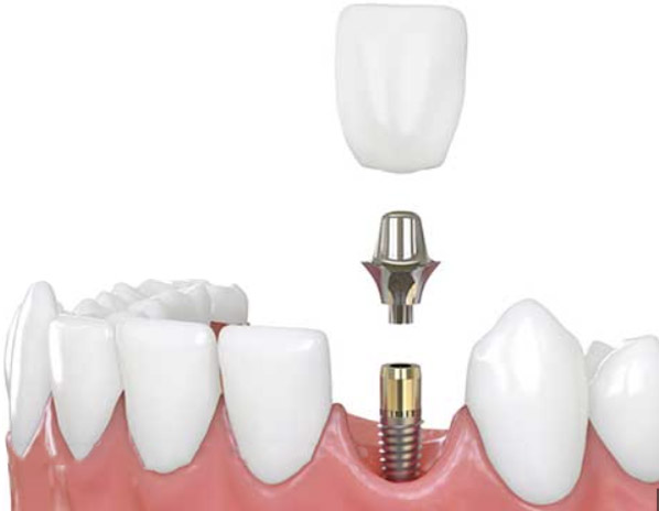 Implant dentar